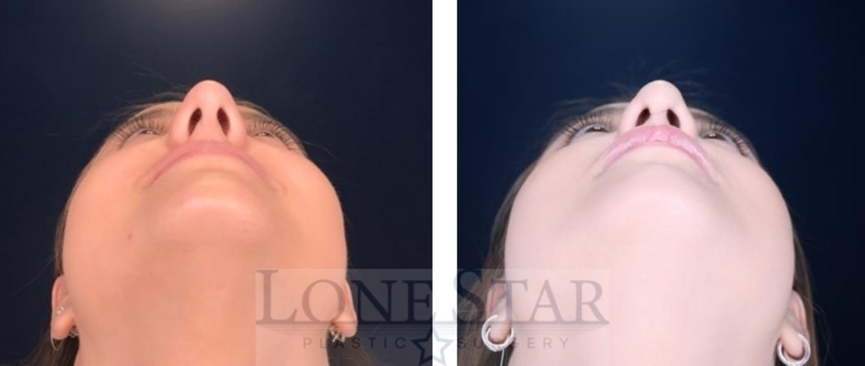 Before & After Rhinoplasty Case 114 Worm's-eye View in Frisco, TX