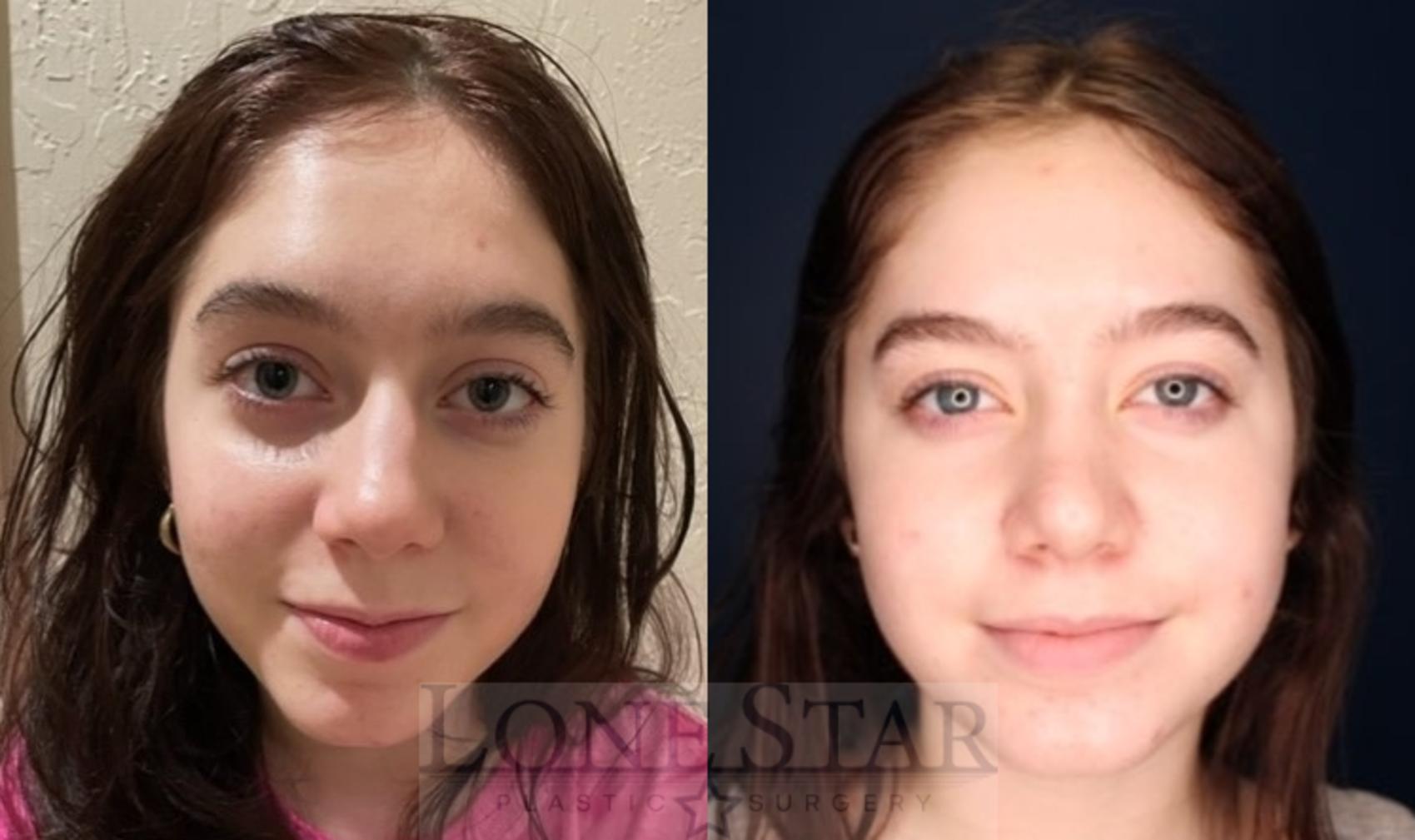 Before & After Rhinoplasty Case 116 Front View in Frisco, TX