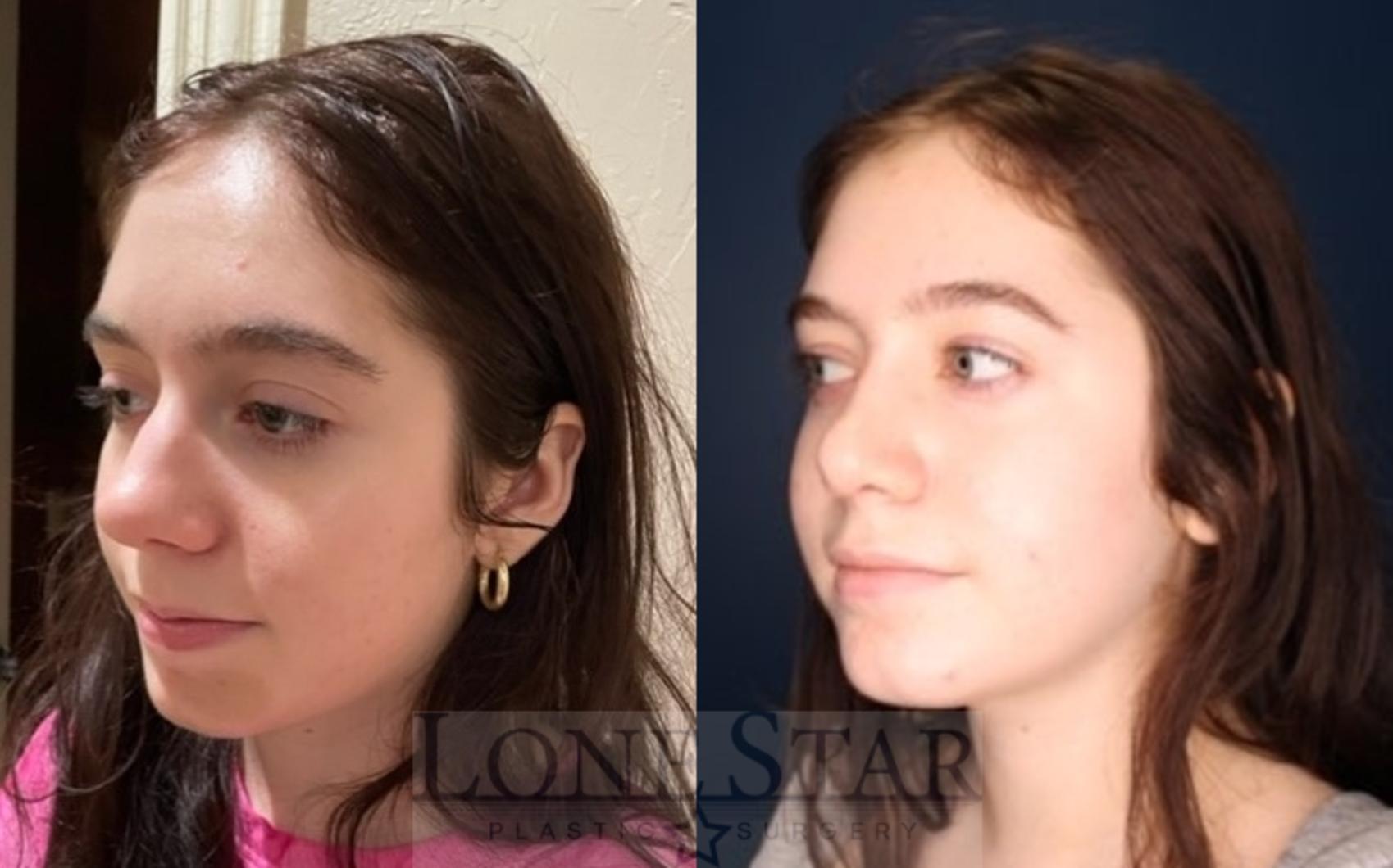 Before & After Rhinoplasty Case 116 Left Oblique View in Frisco, TX