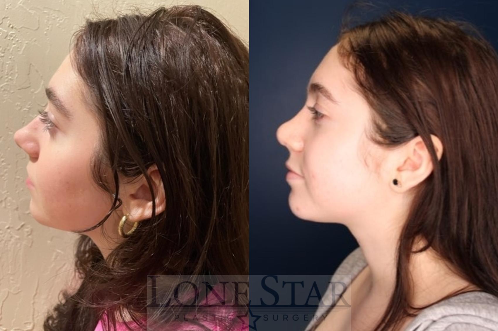 Before & After Rhinoplasty Case 116 Left Side View in Frisco, TX