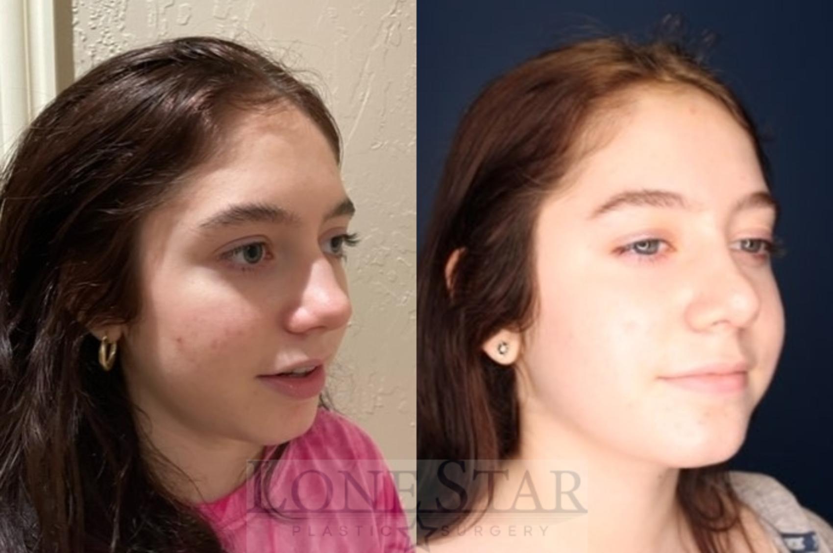 Before & After Rhinoplasty Case 116 Right Oblique View in Frisco, TX