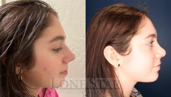 Before & After Rhinoplasty Case 116 Right Side View in Frisco, TX