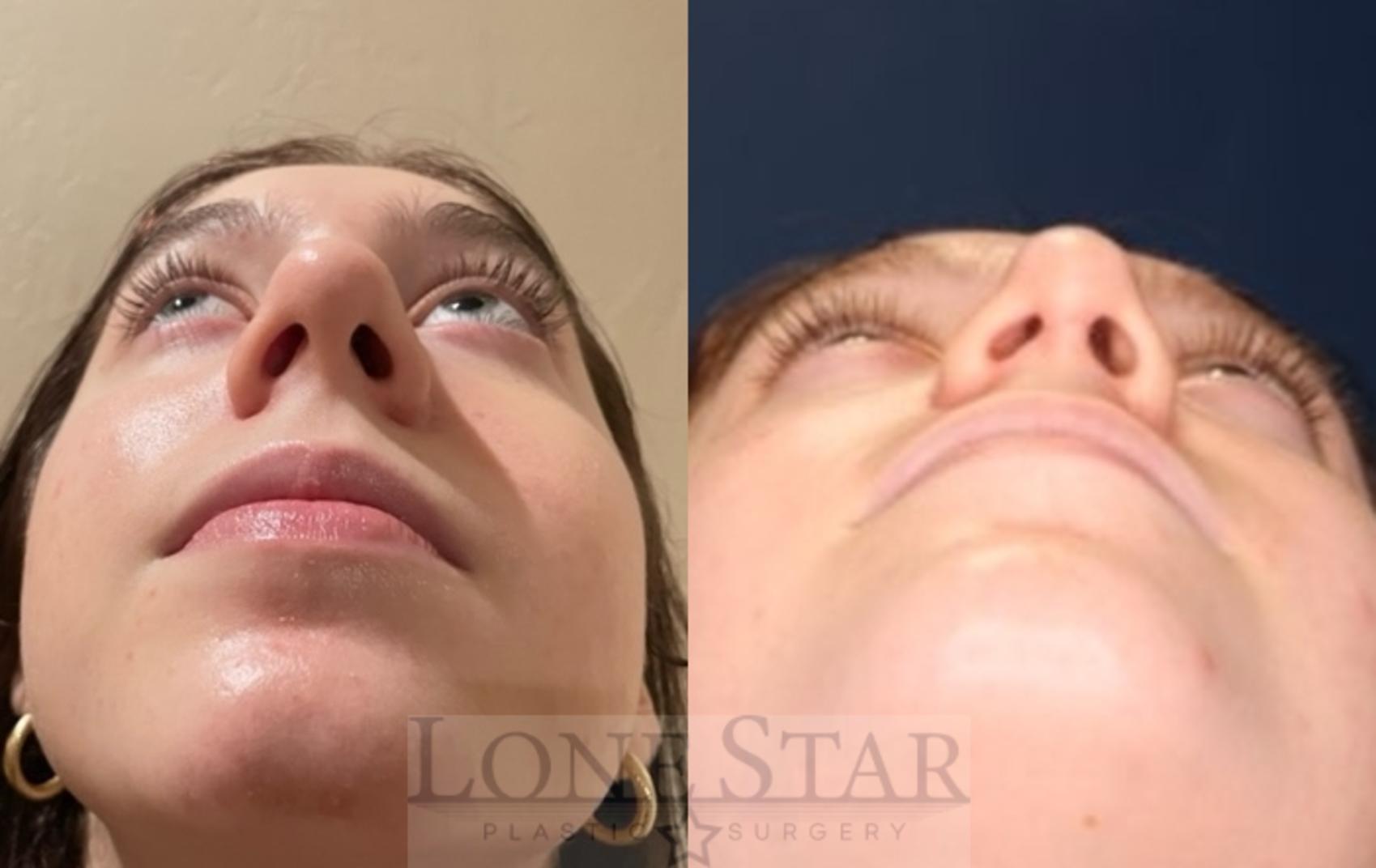 Before & After Rhinoplasty Case 116 Worm's Eye View in Frisco, TX