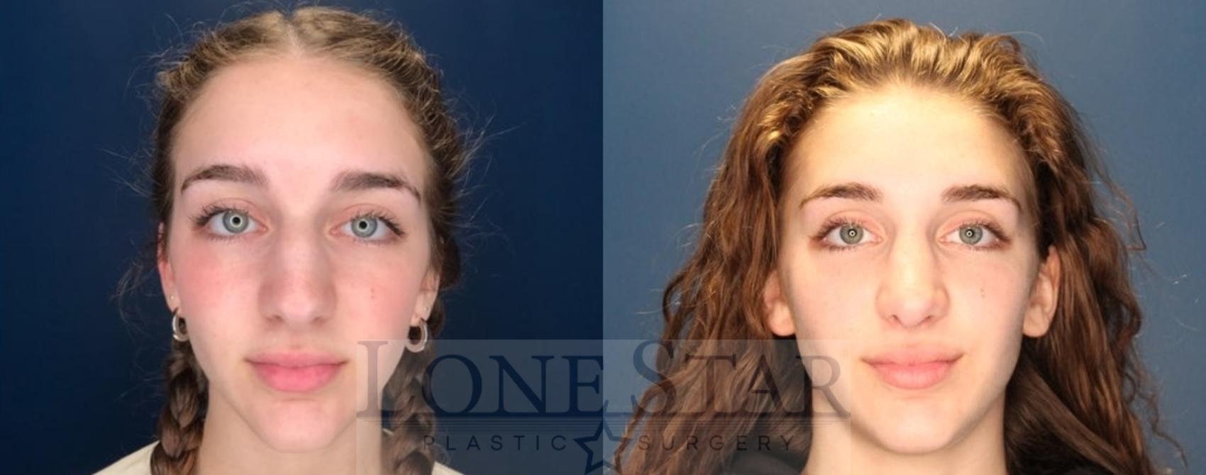 Before & After Rhinoplasty Case 121 Front View in Frisco, TX