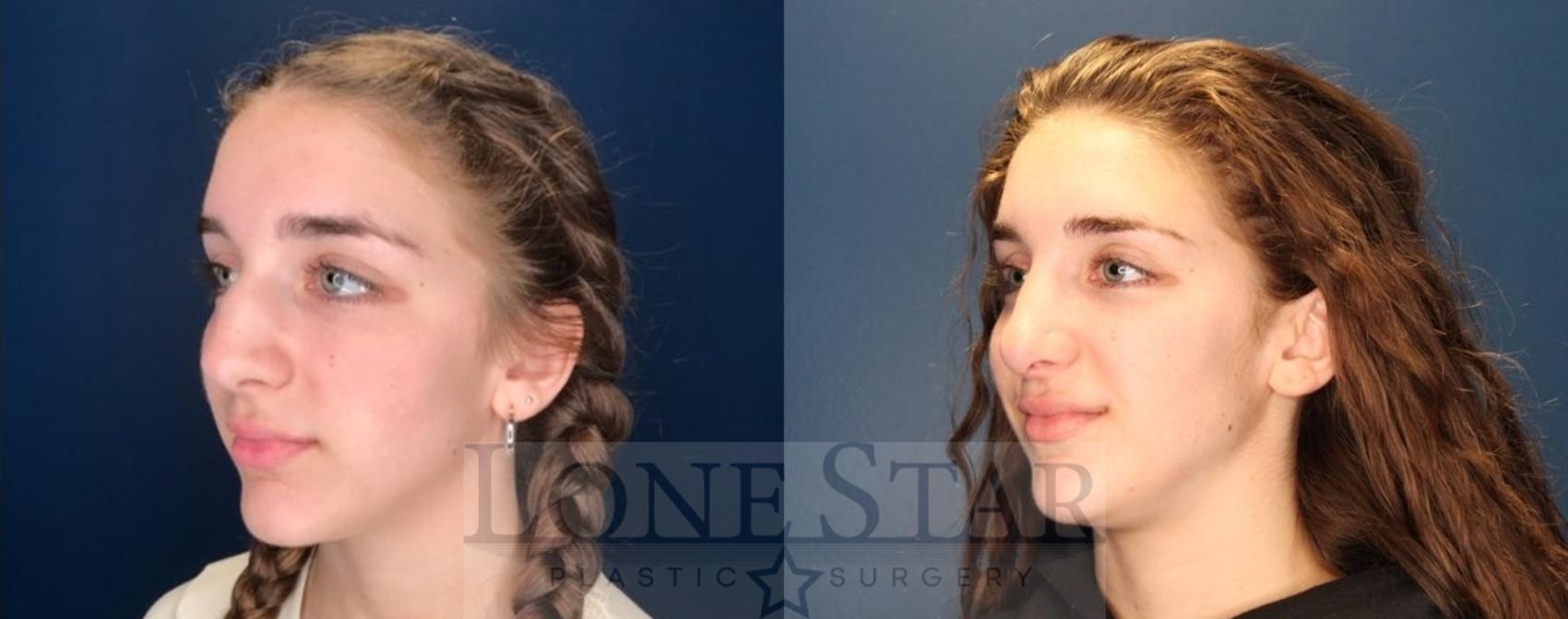 Before & After Rhinoplasty Case 121 Left Oblique View in Frisco, TX