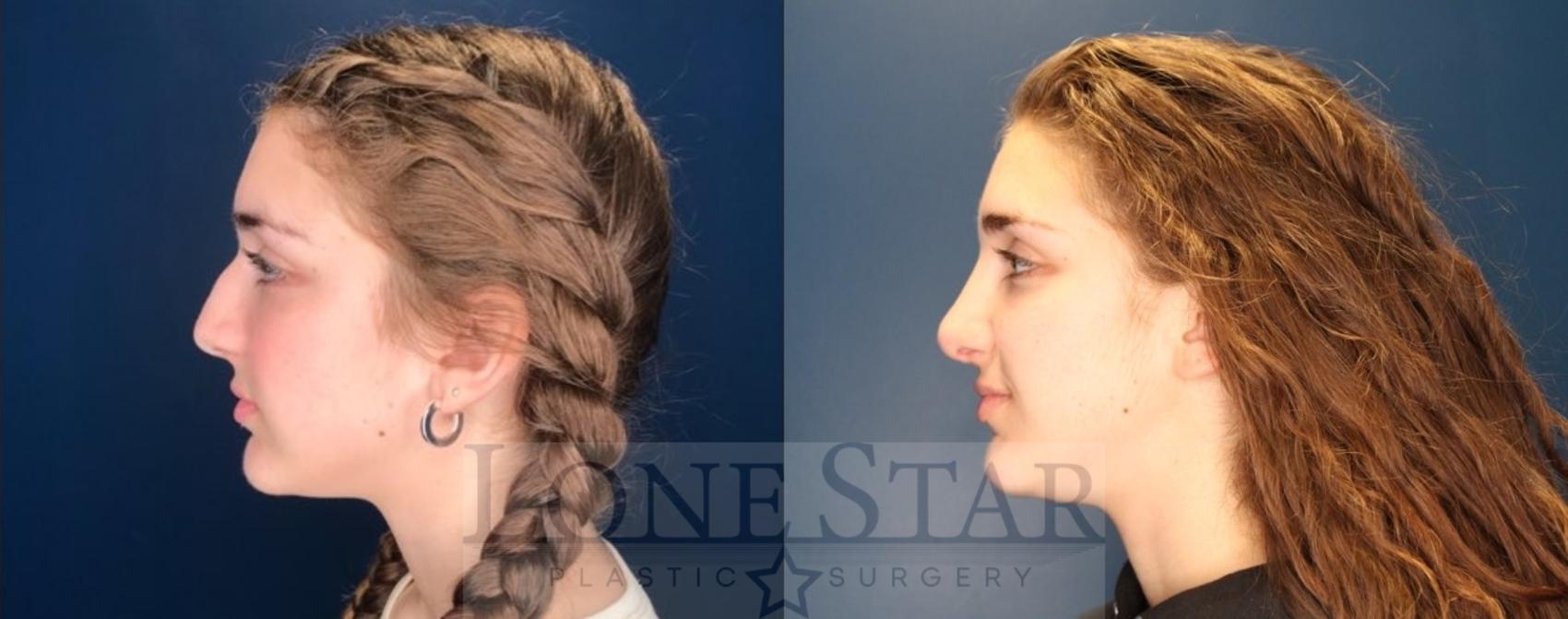 Before & After Rhinoplasty Case 121 Left Side View in Frisco, TX