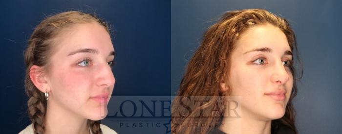 Before & After Rhinoplasty Case 121 Right Oblique View in Frisco, TX
