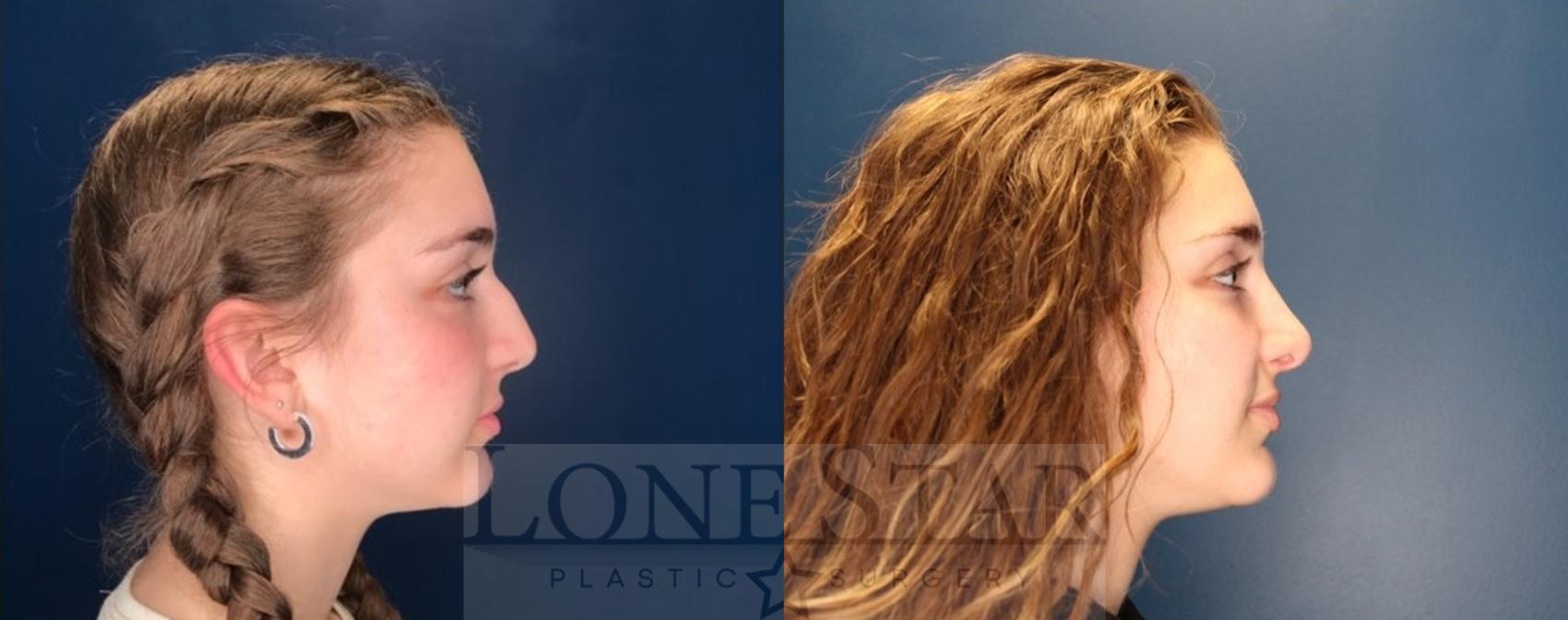 Before & After Rhinoplasty Case 121 Right Side View in Frisco, TX