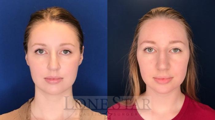 Before & After Rhinoplasty Case 125 Front View in Frisco, TX