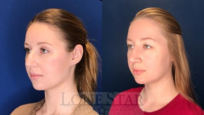 Before & After Rhinoplasty Case 125 Left Oblique View in Frisco, TX