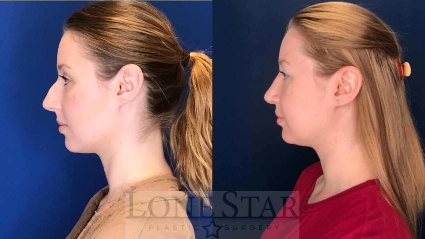Before & After Rhinoplasty Case 125 Left Side View in Frisco, TX