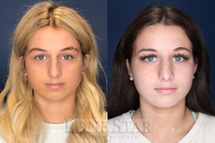 Before & After Rhinoplasty Case 134 Front View in Frisco, TX