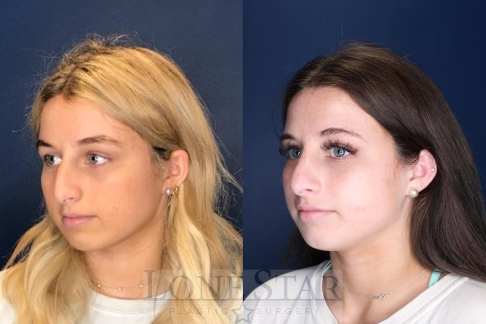 Before & After Rhinoplasty Case 134 Left Oblique View in Frisco, TX