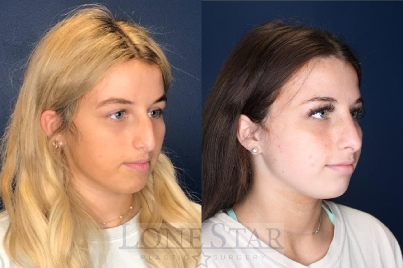 Before & After Rhinoplasty Case 134 Right Oblique View in Frisco, TX