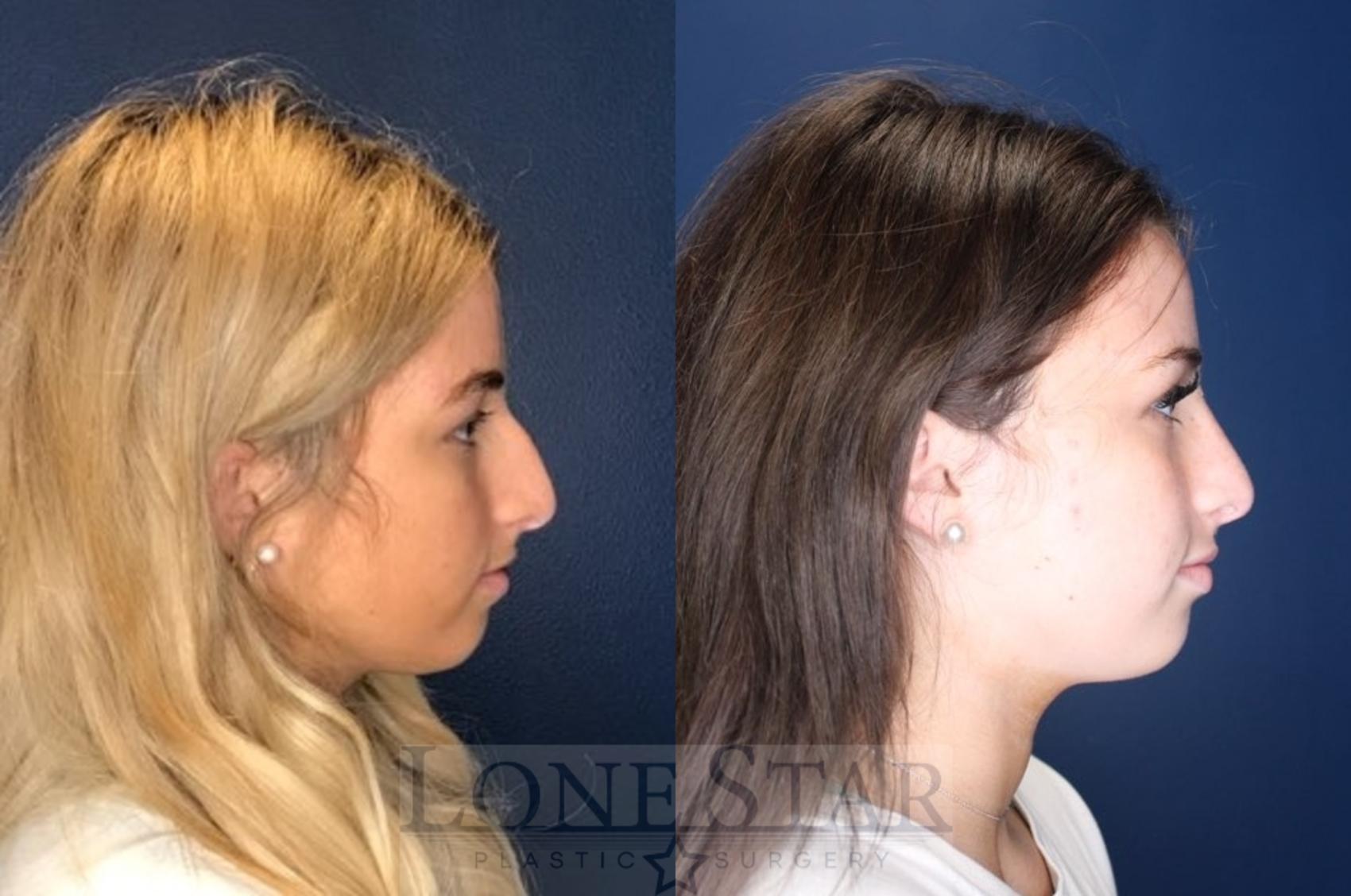 Before & After Rhinoplasty Case 134 Right Side View in Frisco, TX