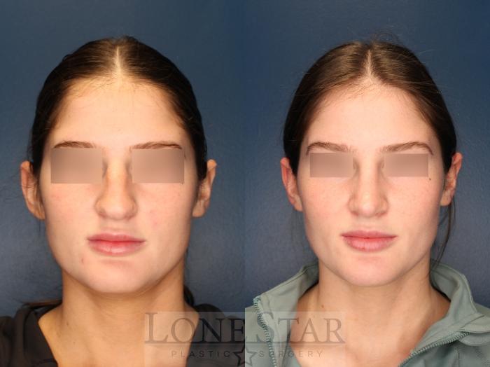 Before & After Rhinoplasty Case 154 Front View in Frisco, TX