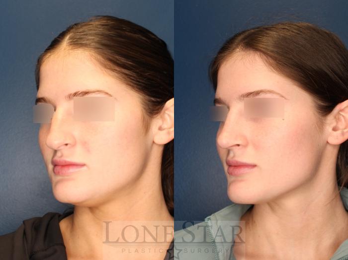Before & After Rhinoplasty Case 154 Left Oblique View in Frisco, TX