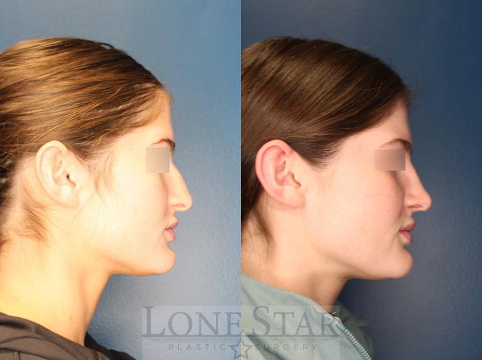 Before & After Rhinoplasty Case 154 Right Side View in Frisco, TX