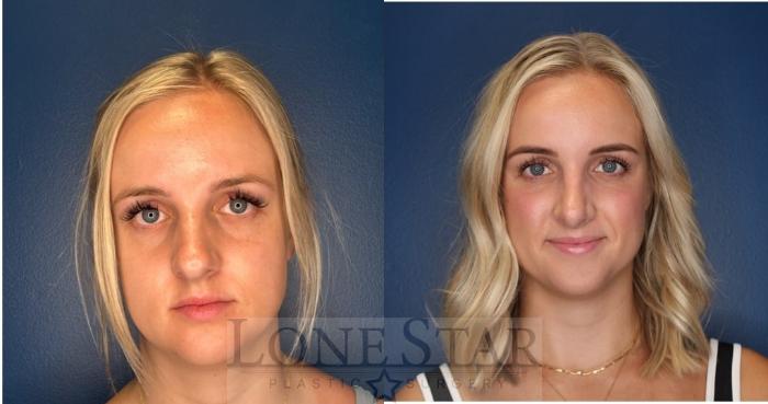 Before & After Rhinoplasty Case 203 Front View in Frisco, TX