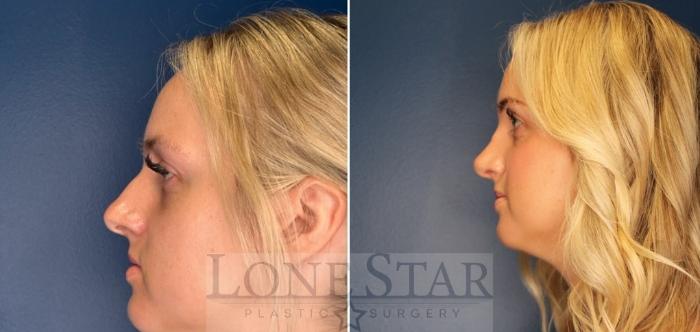 Before & After Rhinoplasty Case 203 Left Side View in Frisco, TX