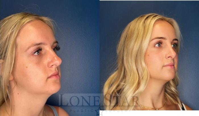 Before & After Rhinoplasty Case 203 Right Oblique View in Frisco, TX