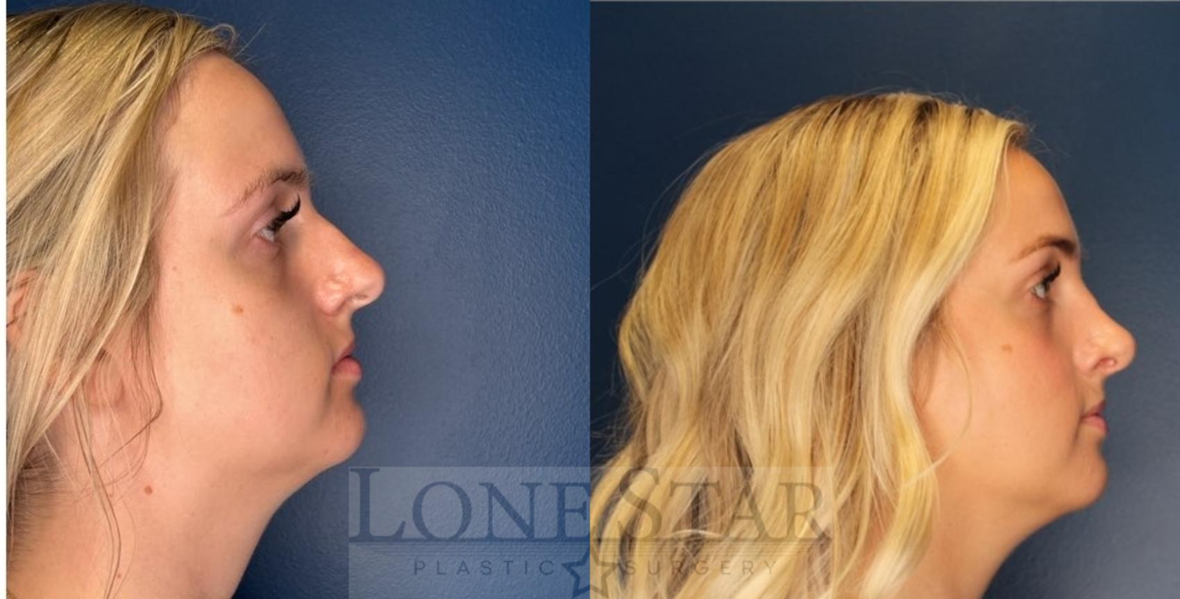 Before & After Rhinoplasty Case 203 Right Side View in Frisco, TX