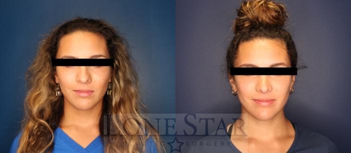 Before & After Rhinoplasty Case 205 Front View in Frisco, TX