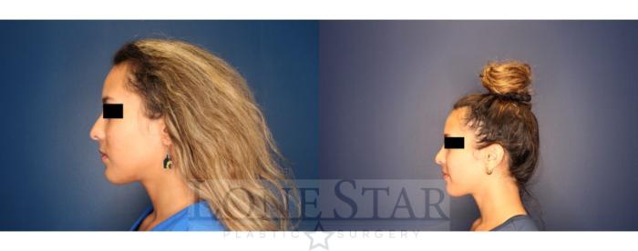 Before & After Rhinoplasty Case 205 Left Side View in Frisco, TX