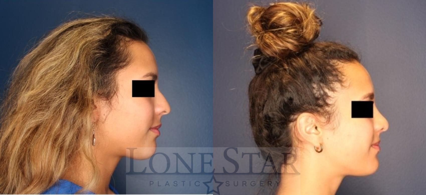 Before & After Rhinoplasty Case 205 Right Side View in Frisco, TX