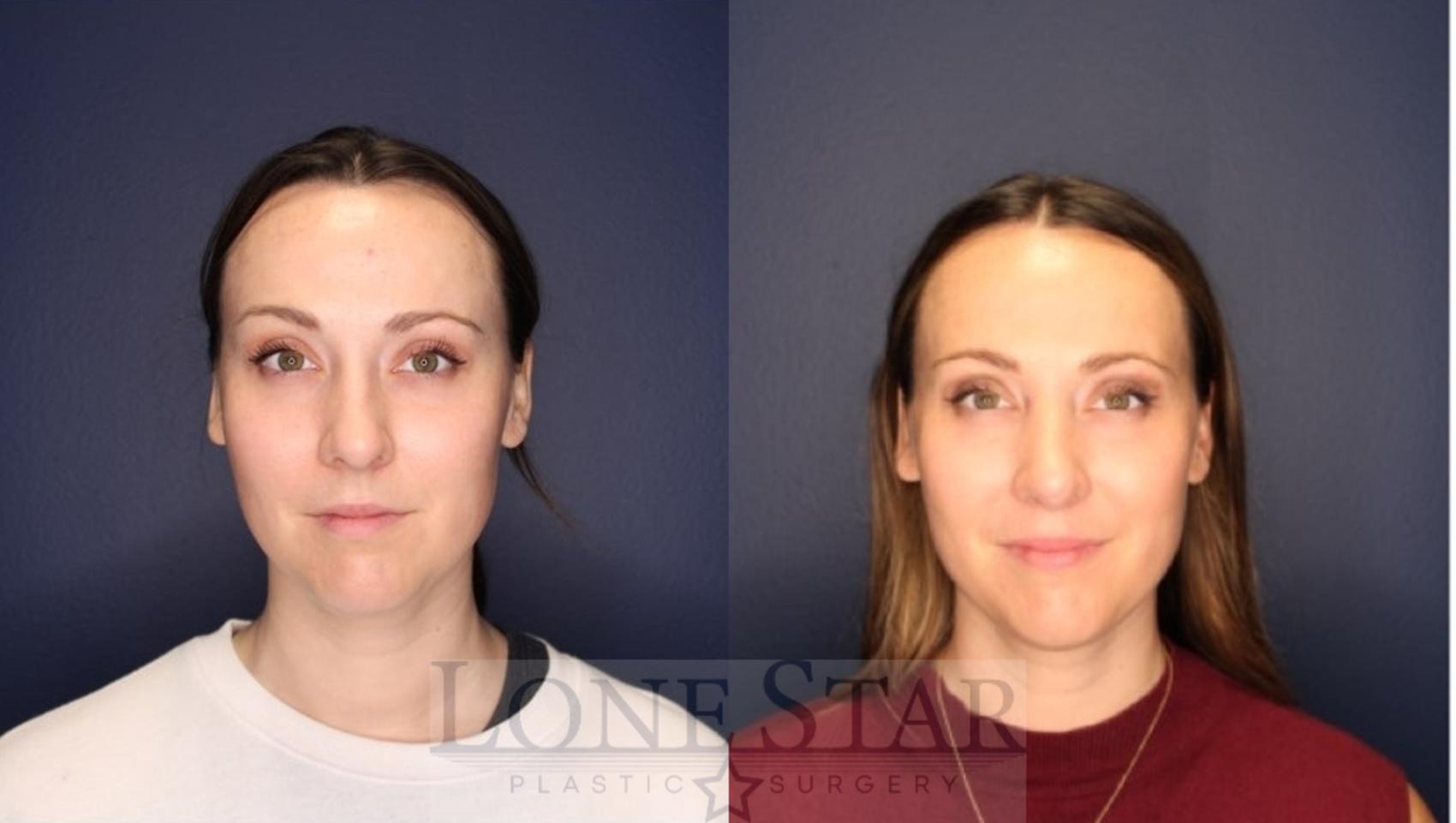 Before & After Rhinoplasty Case 219 Front View in Frisco, TX