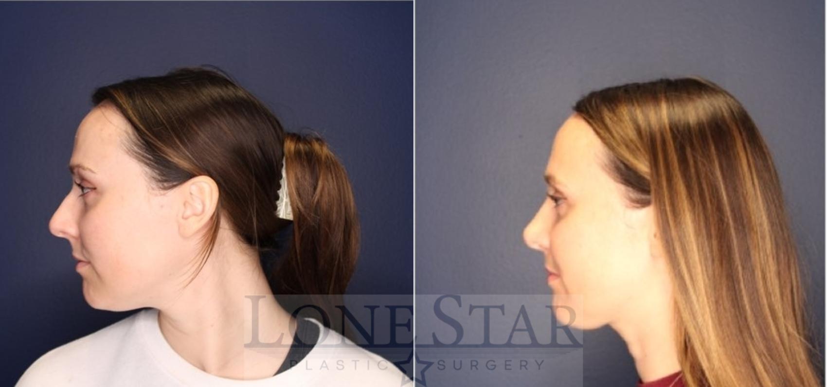 Before & After Rhinoplasty Case 219 Left Side View in Frisco, TX