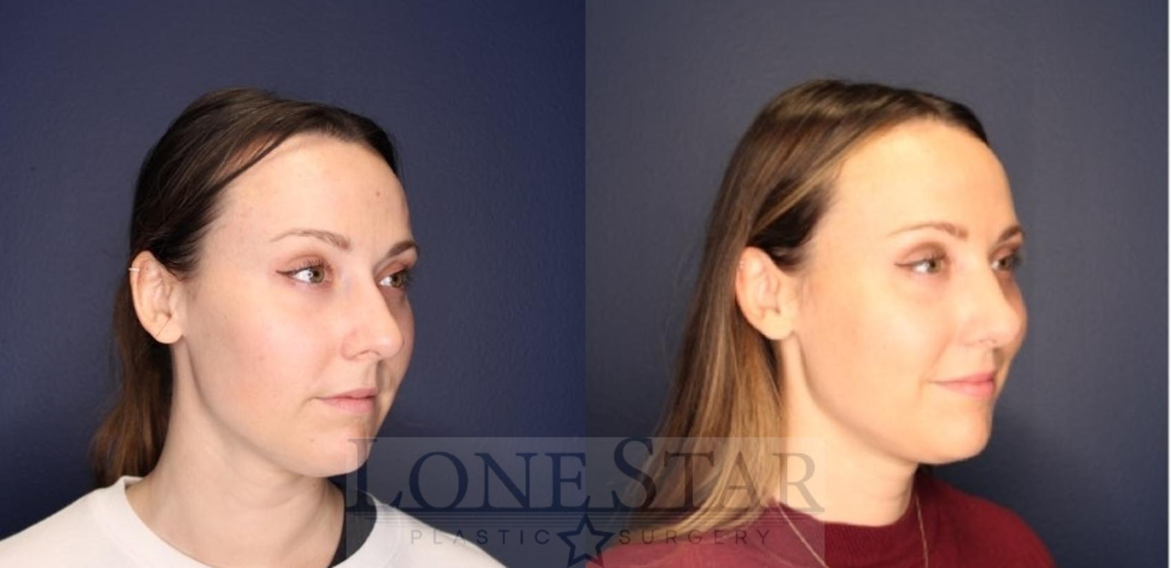 Before & After Rhinoplasty Case 219 Right Oblique View in Frisco, TX
