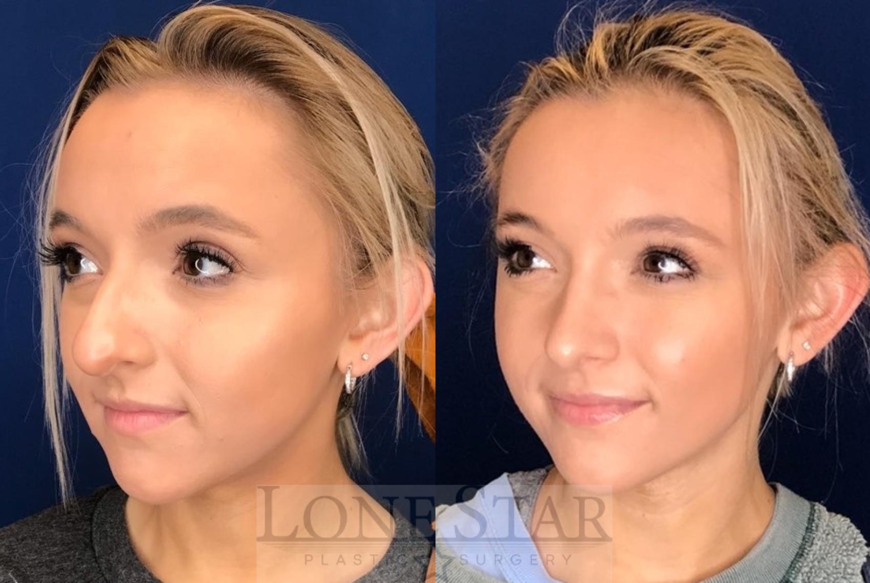 Before & After Rhinoplasty Case 52 corner view View in Frisco, TX