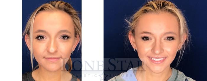 Before & After Rhinoplasty Case 52 Front View in Frisco, TX