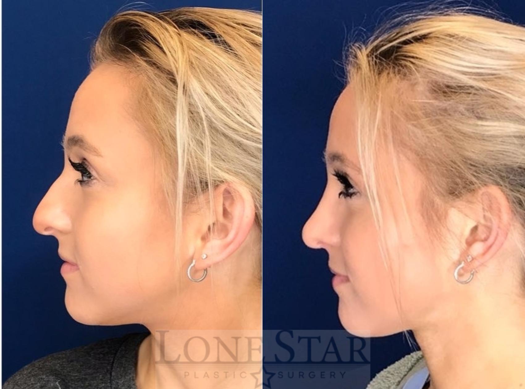 Before & After Rhinoplasty Case 52 Left Side View in Frisco, TX
