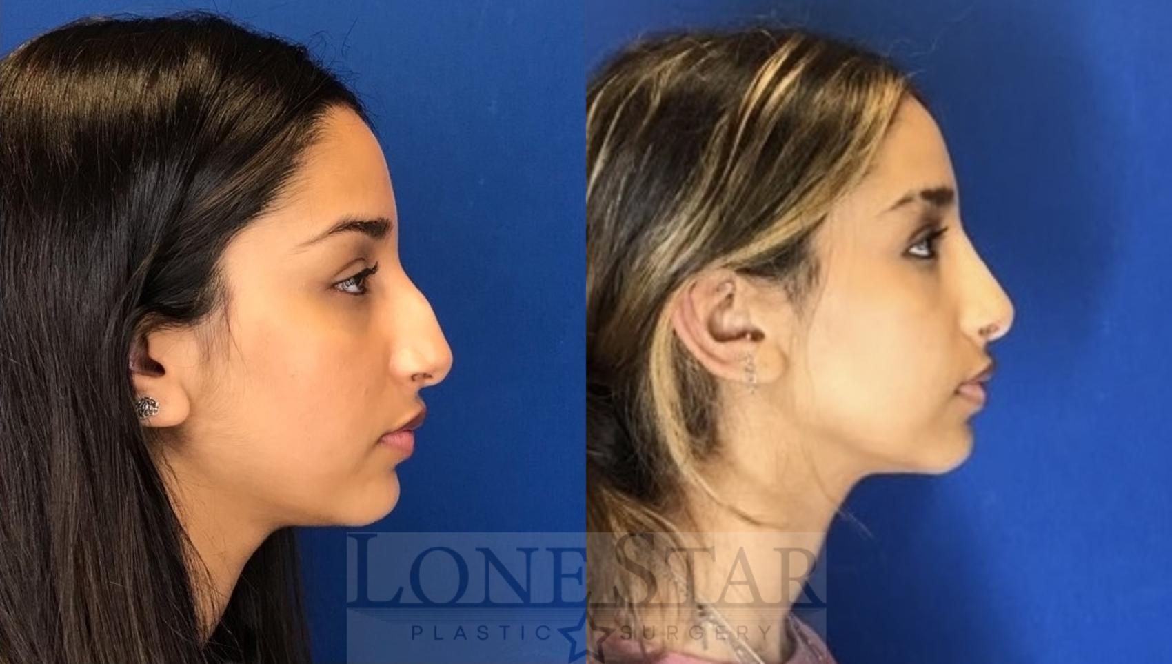 Before & After Rhinoplasty Case 56 Right Side View in Frisco, TX