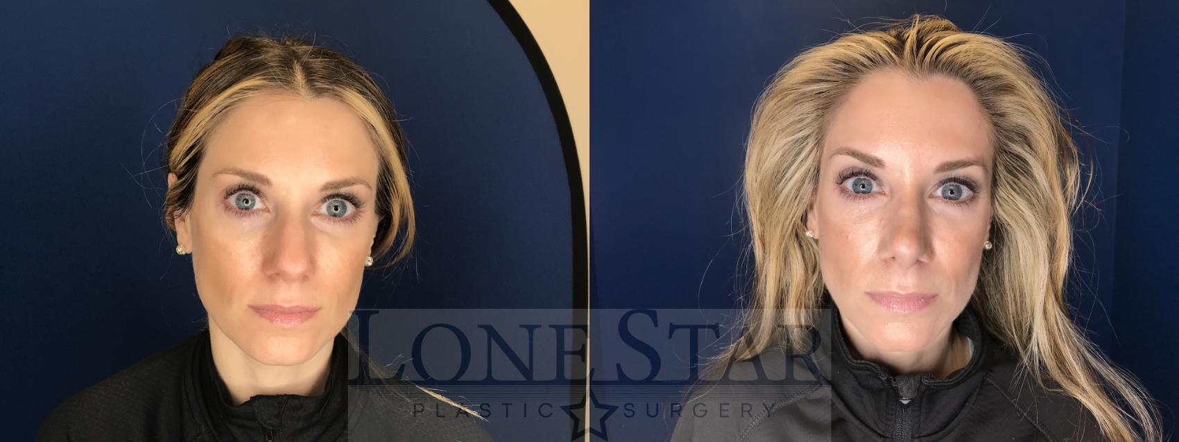 Before & After Rhinoplasty Case 71 Front View in Frisco, TX