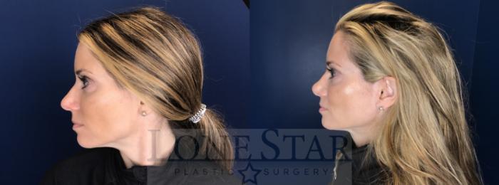 Before & After Rhinoplasty Case 71 Left Side View in Frisco, TX