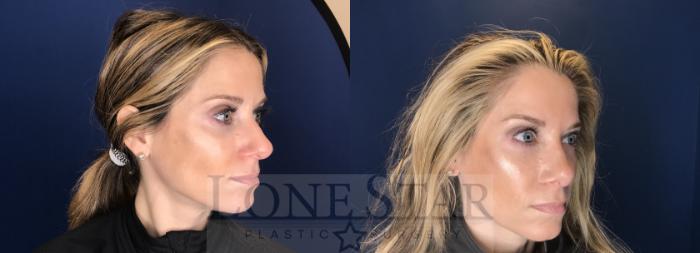 Before & After Rhinoplasty Case 71 Right Side View in Frisco, TX