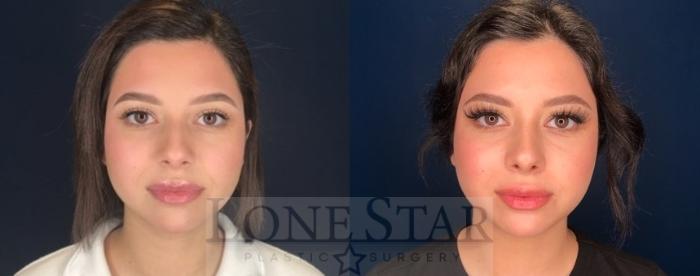 Before & After Rhinoplasty Case 75 Front View in Frisco, TX