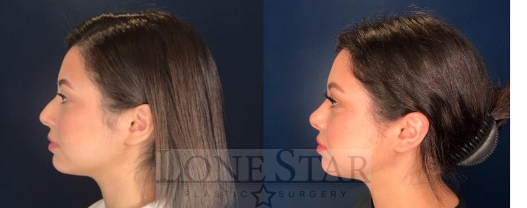 Before & After Rhinoplasty Case 75 Left Side View in Frisco, TX
