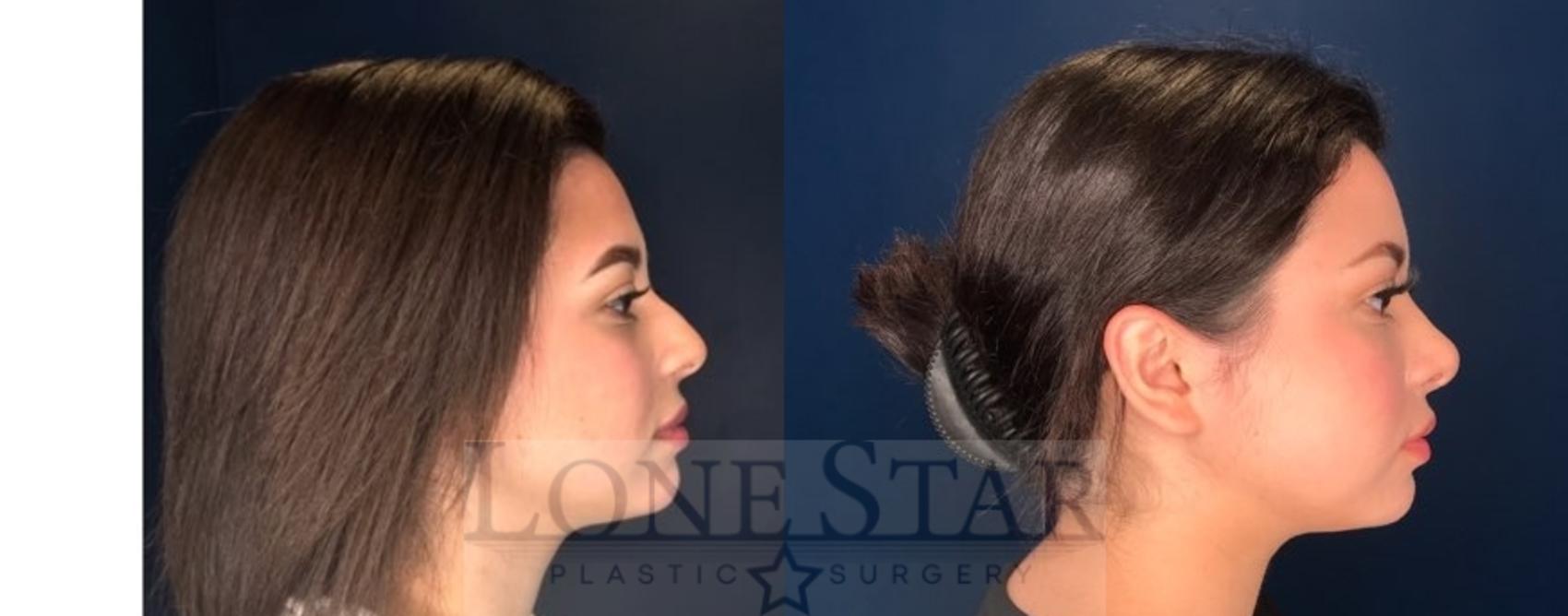 Before & After Rhinoplasty Case 75 Right Side View in Frisco, TX