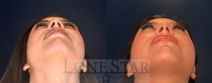 Before & After Rhinoplasty Case 75 Worm's-eye View in Frisco, TX