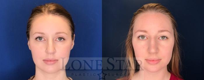 Before & After Rhinoplasty Case 76 Front View in Frisco, TX