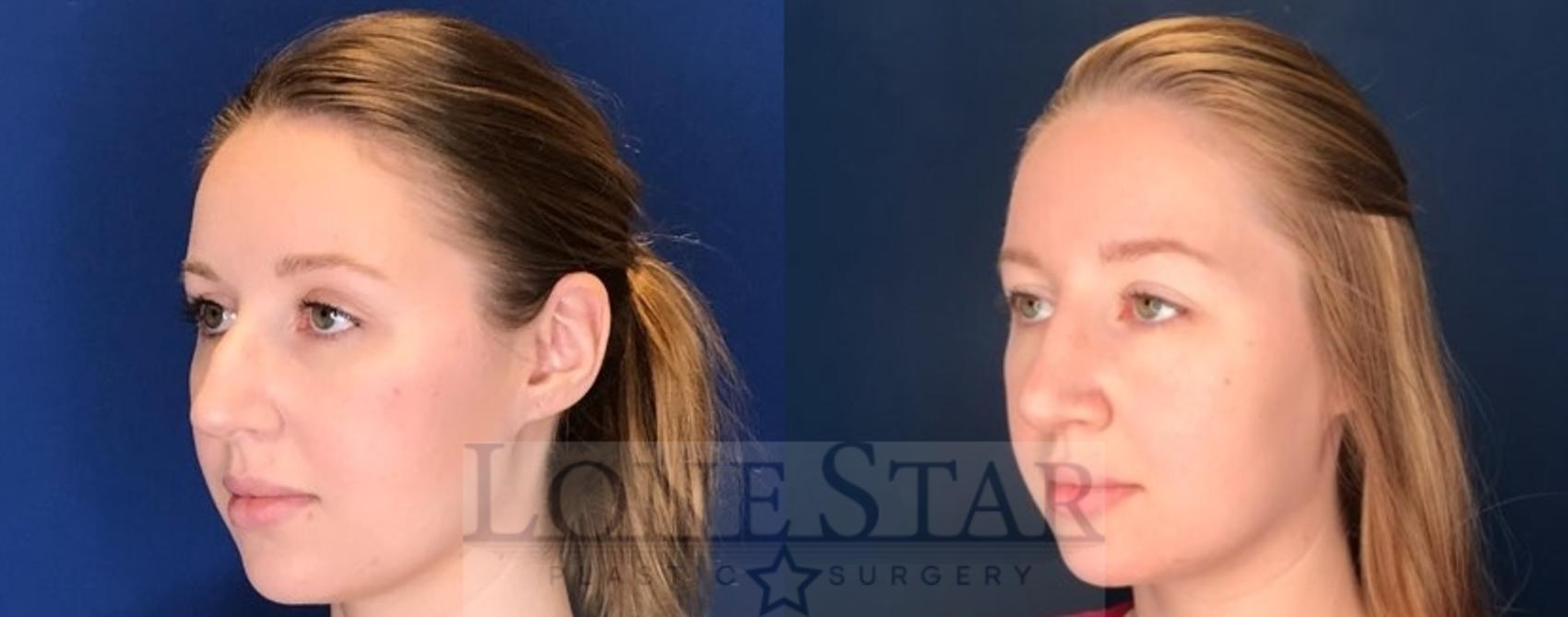 Before & After Rhinoplasty Case 76 Left Oblique View in Frisco, TX