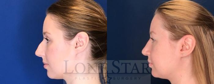Before & After Rhinoplasty Case 76 Left Side View in Frisco, TX