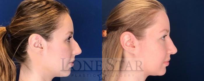Before & After Rhinoplasty Case 76 Right Side View in Frisco, TX