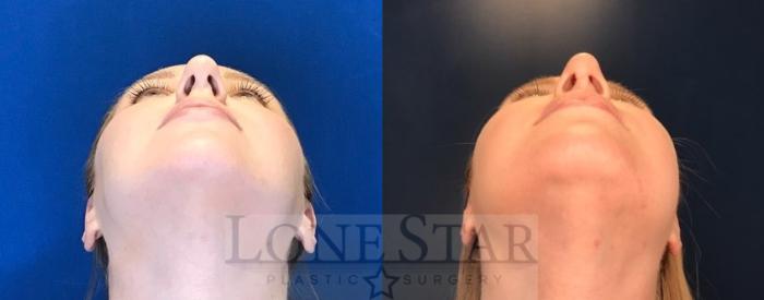 Before & After Rhinoplasty Case 76 Worm's-eye View in Frisco, TX