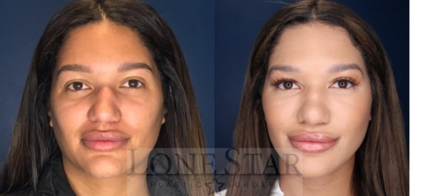 Before & After Rhinoplasty Case 85 Front View in Frisco, TX