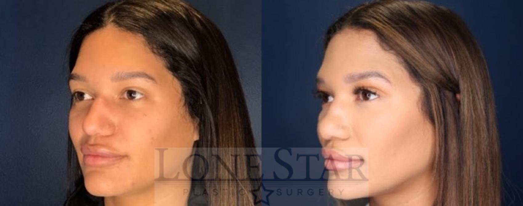 Before & After Rhinoplasty Case 85 Left Oblique View in Frisco, TX